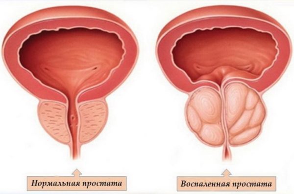 Възпаление на простатата