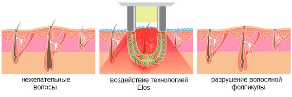  Елос технология за премахване на косата